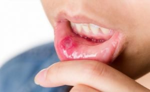 How to Cure Canker Sore or Mouth Ulcers at Home Naturally?