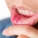 How to Cure Canker Sore or Mouth Ulcers at Home Naturally?