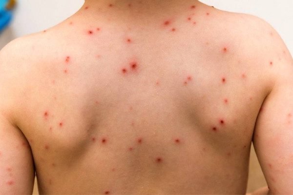 How to Cure Chickenpox at Home Naturally?