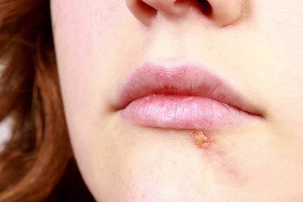 How to Cure Cold Sores at Home Naturally?