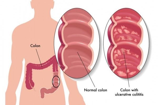 How to Cure Colitis at Home Naturally?