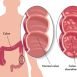 How to Cure Colitis at Home Naturally?