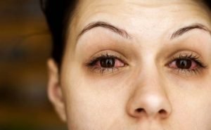 How to Cure Conjunctivitis at Home Naturally?