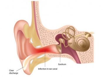 How to Cure Ear Infection at Home Naturally?
