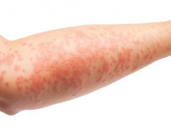 How to Cure Eczema at Home Naturally?