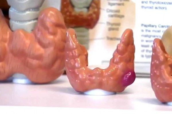 How to Cure Goitre at Home Naturally?
