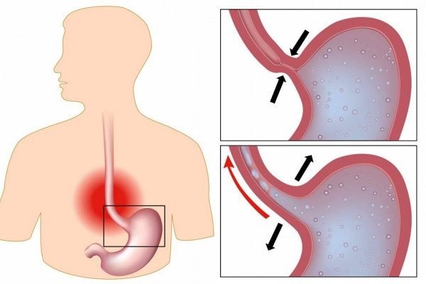 How to Cure Indigestion at Home Naturally?