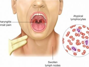 How to Cure Infectious Mononucleosis Naturally?