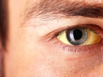 How to Cure Jaundice at Home Naturally?