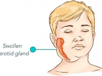 How to Cure Mumps at Home Naturally?