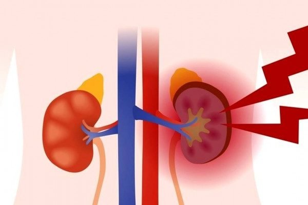How to Cure Nephritis at Home Naturally?