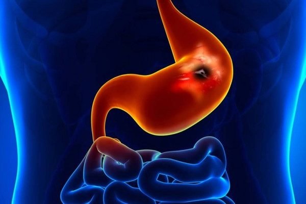 How to Cure Peptic Ulcer at Home Naturally?