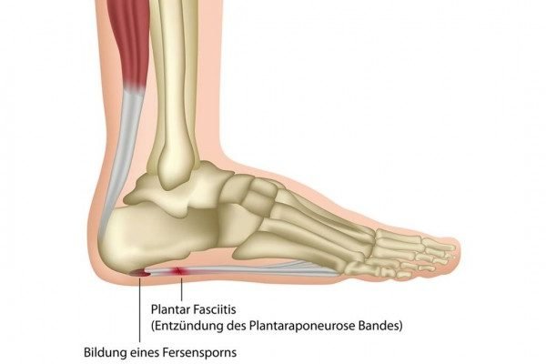How to Cure Plantar Fascia or Plantar Fasciitis Naturally?