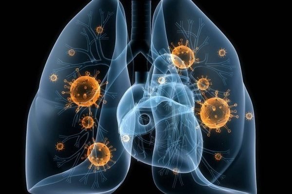 How to Cure Pneumonia at Home Naturally?