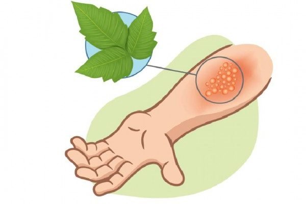 How to Cure Poison IVY Naturally?