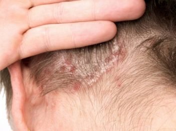 How to Cure Psoriasis of the Skin Naturally?