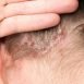 How to Cure Psoriasis of the Skin Naturally?