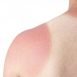 How to Cure Sunburn at Home Naturally?