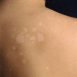 How to Cure Tinea Versicolor at Home Naturally?
