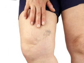 How to Cure Varicose Veins at Home Naturally?