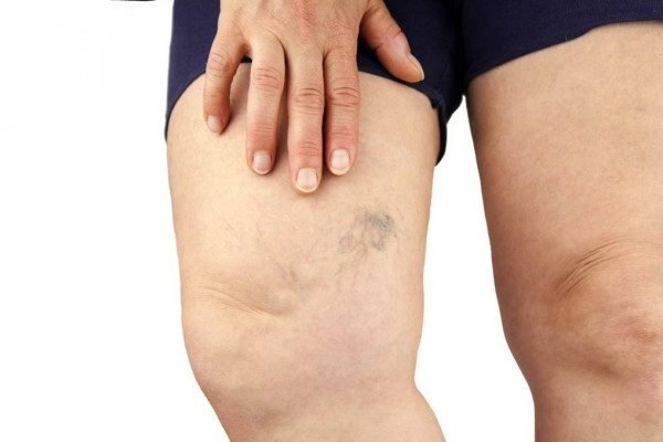 How to Cure Varicose Veins at Home Naturally?