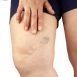 How to Cure Varicose Veins at Home Naturally?