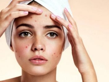 How to get rid of Acne at Home Naturally?