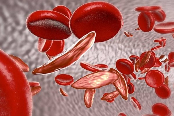 How to get rid of Anaemia at Home Naturally?