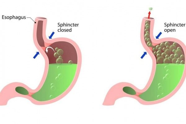How to get rid of Belching at Home Naturally?