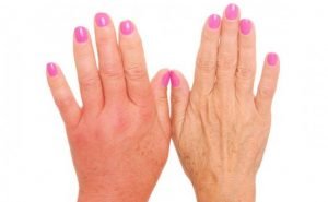 How to get rid of Dropsy at Home Naturally?