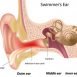 How to Get Rid of Swimmers Ear at Home Naturally?