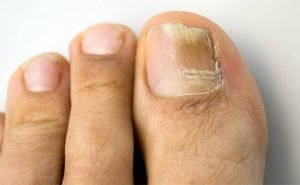 How to Treat Nail Fungus Infection at Home Naturally?