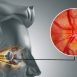 How to Treat Neuritis at Home Naturally?