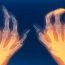 I am taking medicines for my arthritis but I have observed that because of it, my stomach remains upset, why is to so?