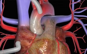 I am to undergo coronary by pass. What exactly is that?