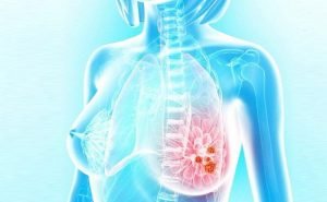 I have got mammography done and after the tests I was asked to go back. I am quite tense as I think I have cancer.