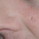 I have 'rodent ulcer' on my face. What is it?