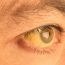 I have yellow patches around my eyes. What is the problem?