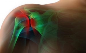 I still experience lot of pain in my shoulders although its quite some time now since I fractured them. Why is it taking so much time?