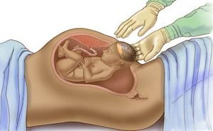 In what cases, caesarean is done?