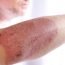 Is dermatitis contagious?