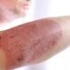 Is dermatitis contagious?