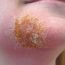 Is impetigo contagious?