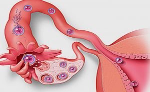 Is salpingitis a contributory factor for infertility?