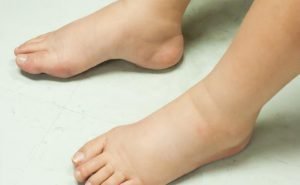 My ankles swell up a lot. What is the reason for this?