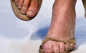 My feet swell in the hot weather. Why is it so?