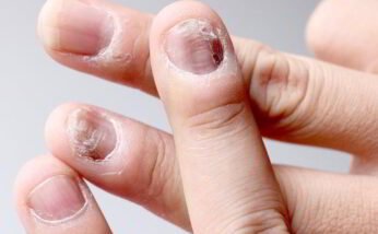 My nails are becoming cracked. What is the problem?