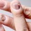 My nails are becoming cracked. What is the problem?