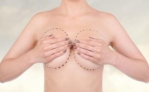 Please tell me about subcutaneous mastectomy?