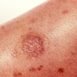 Should I take antibiotics in case of love bites?
